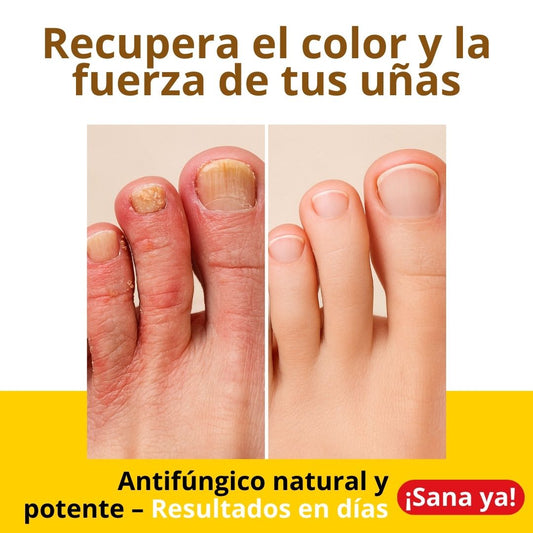 Tratamiento para Hongos de las uñas y pies - DoctorOzono